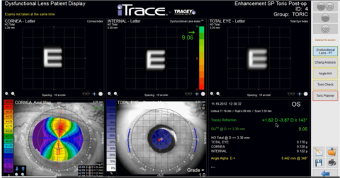 itrace toric lens alignment