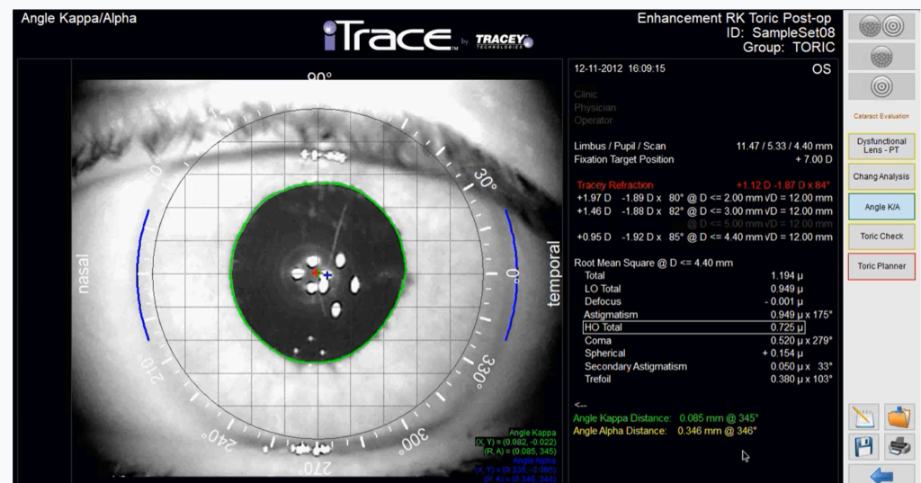 itrace toric lens alignment