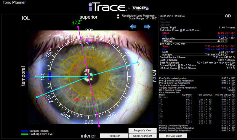 tracey itrace used